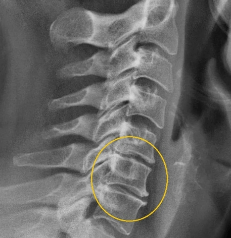 Osteohondroza materničnega vratu